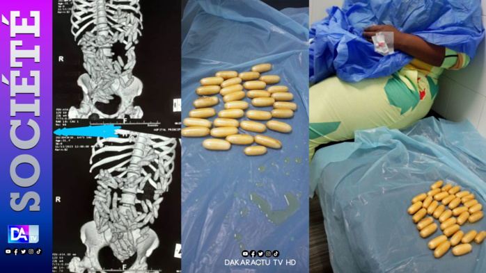 AIBD/ Interpellation d'une mule de nationalité sud-africaine: Admise à l'hôpital, la dame a expulsé 92 boulettes testées positives à la cocaïne