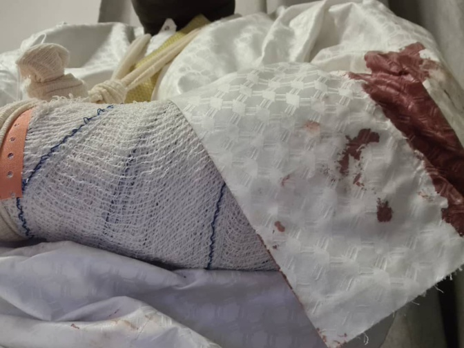 Après l’attaque du cortège de Sonko à Koungheul: Malick Gakou s’en sort avec une fracture ouverte de l'avant bras gauche